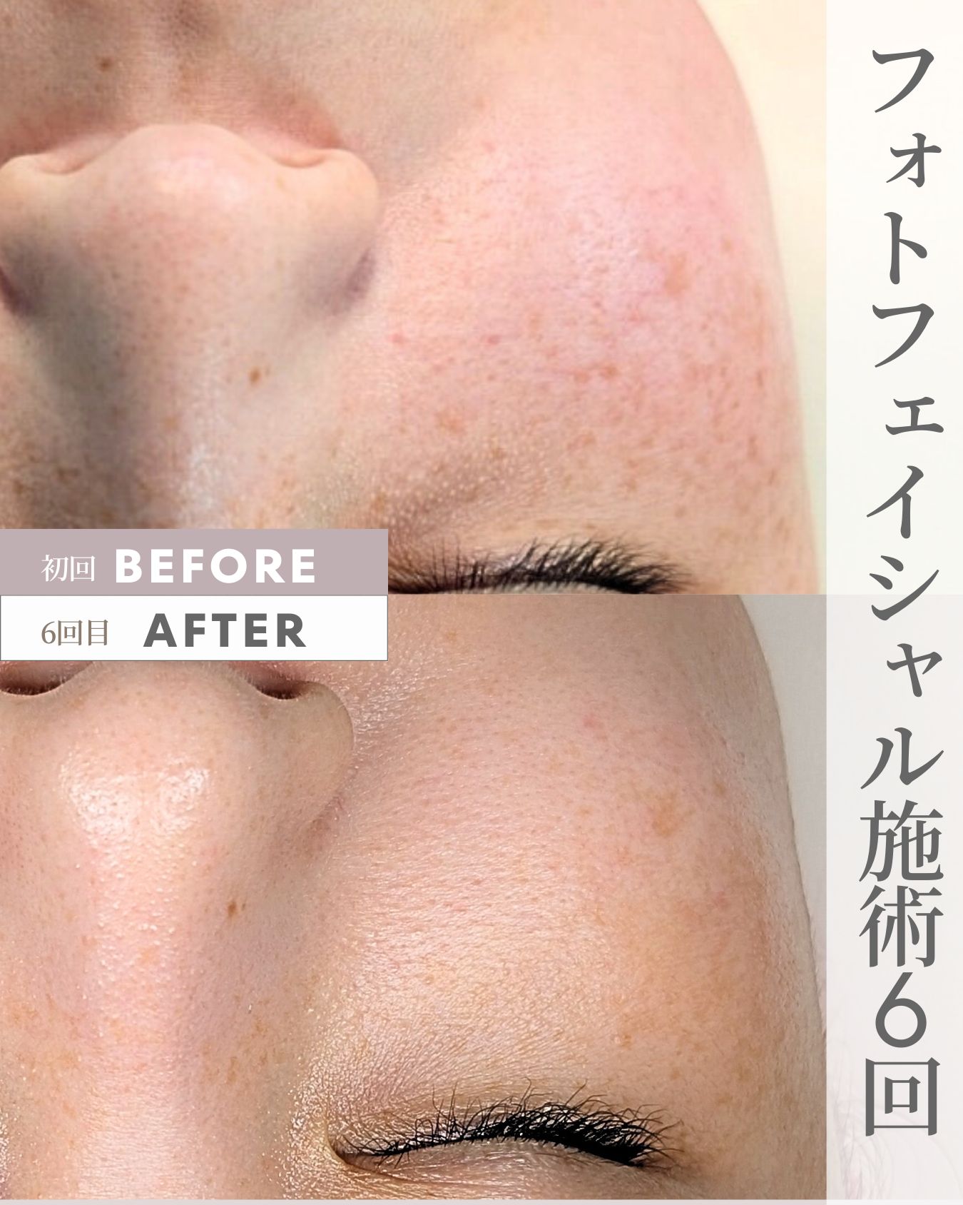 フォトフェイシャル 6回目 ビフォーアフター